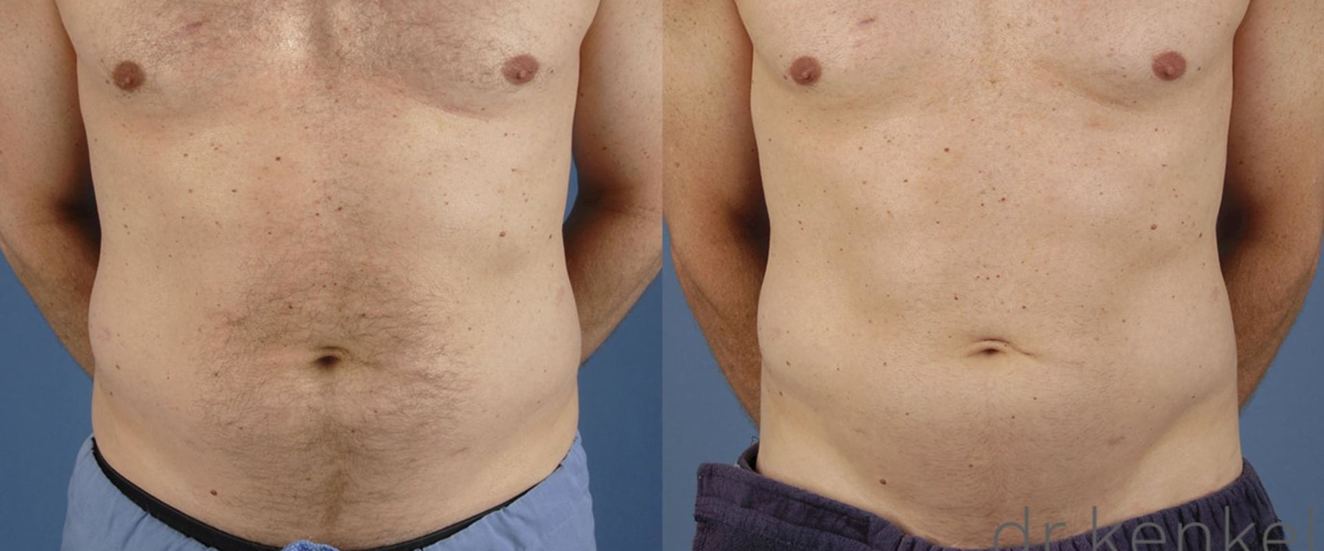The Positive Effects Of Coolsculpting On Your Mind And Body Wellness In Dallas, TX